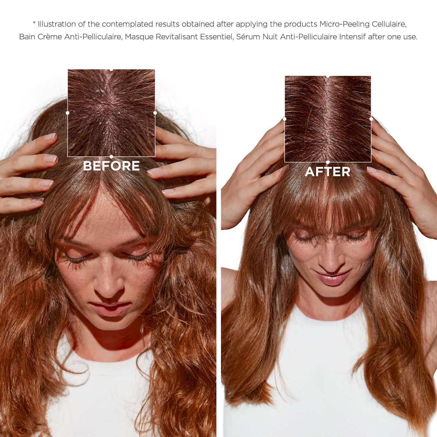 Symbiose Before and After to fight dandruff on oily scalp - Front